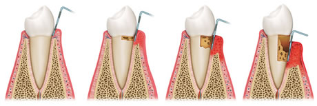Entzündung des marginalen Zahnfleisches