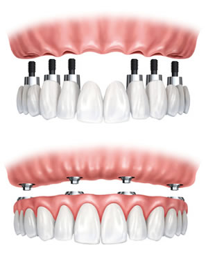Darstellung verschiedener Zahnimplantate