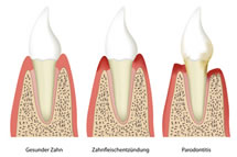 gesunder Zahn, Zahnfleischentzündung, Parodontitis