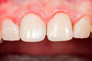 schöne Zähne nach der Zahnerhaltung