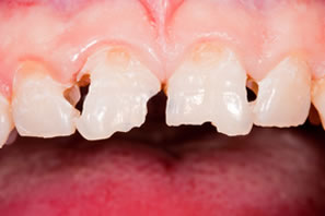 kaputte Zähne vor der Zahnerhaltung