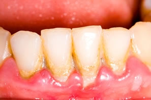 Zahnstein bei entzündeten Zähnen